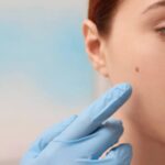 Tips for Treating Thread Veins and Skin Pigmentation